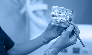Research : Accuracy Of Digital And Conventional Implant-level Impression Techniques For Maxillary Full-arch Screw-retained Prosthesis: A Crossover Randomized Trial